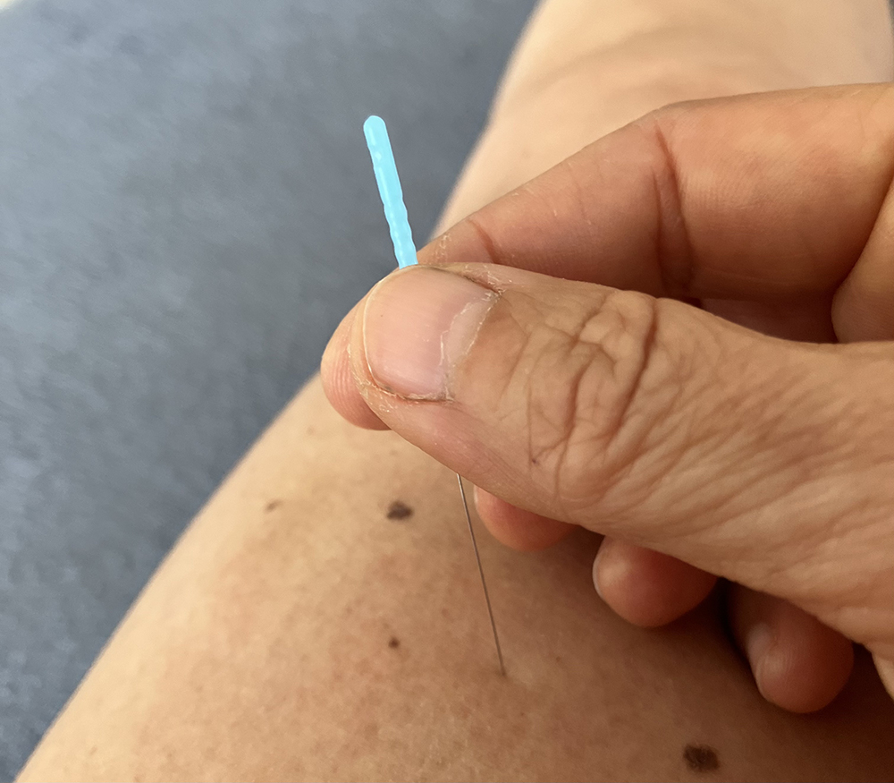 Dry Needling behandeling